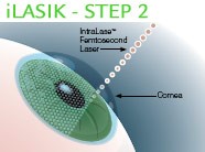 iLASIK - step 2